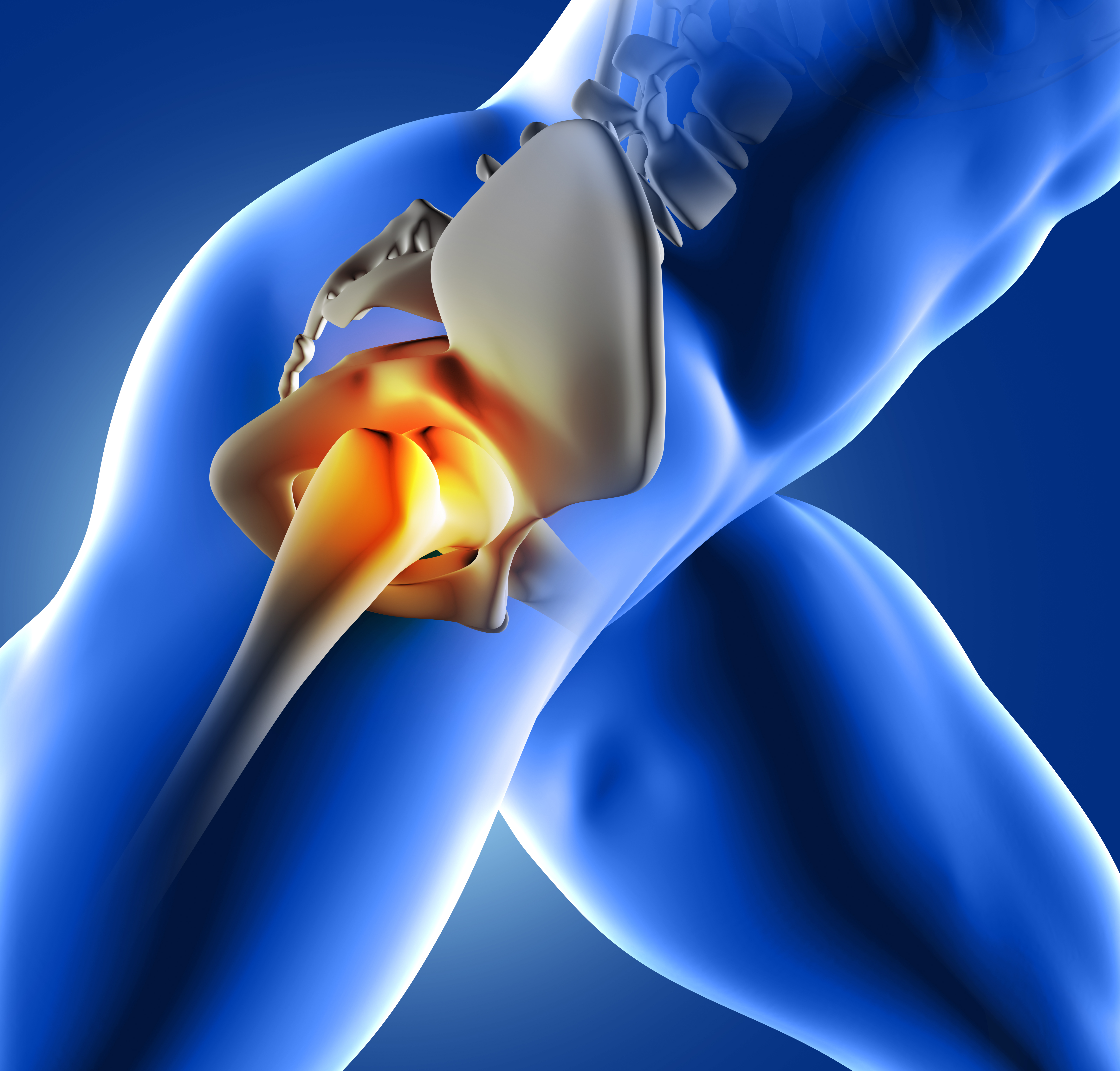 Hip Replacement